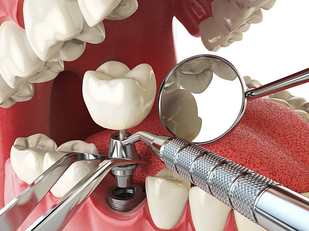 Best Emergency Tooth Extraction in Colchester, IL